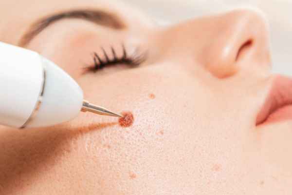 CryoPen: 5 Skin Concerns It May Be Used to Treat 3 What actually happens during a CryoPen treatment Warley?