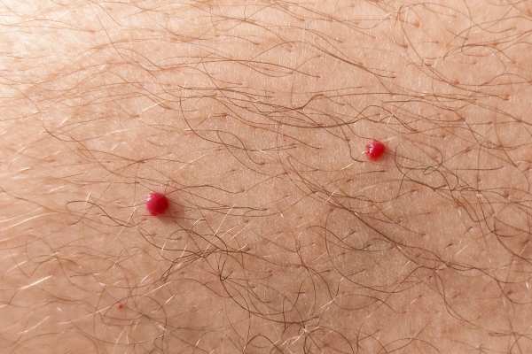 CryoPen: 5 Skin Concerns It May Be Used to Treat 2 cherry angioma removal Warley