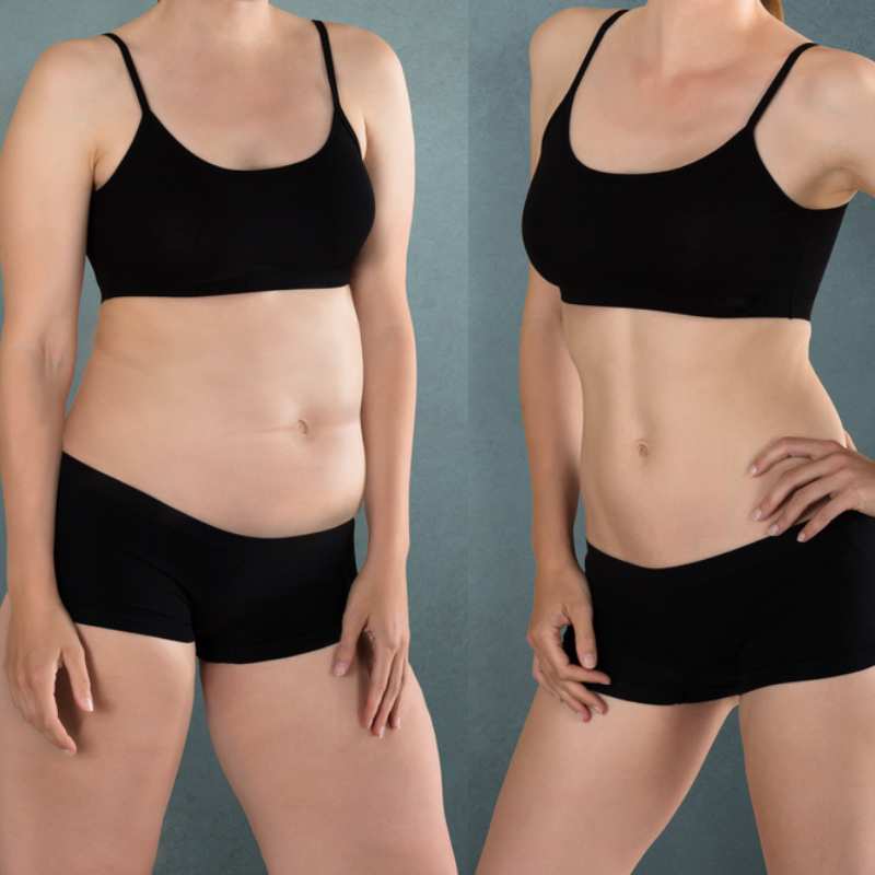 Does Fat Freezing at Home Work? DIY Devices vs Professional Cryolipolysis 2 before and after Cryolipolysis Warley
