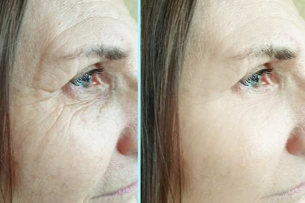 Why Do People Choose HIFU for a Non-Surgical Facelift? 4 How long can HIFU results last Warley?